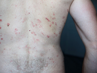 CLOSE UP: An unrecognized man suffering from an autoimmune incurable dermatological skin disease called psoriasis. Large red, inflamed rash all over the body. Stains of different sizes