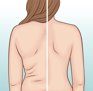 Women's back before and after weight loss. Folds on the back.