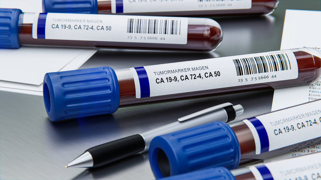 Biomarker oder Tumormarker Magenkrebs