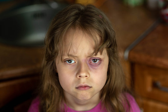 Portrait Of A Sad And Scared Little Girl With Beating. Child Domestic Abuse.