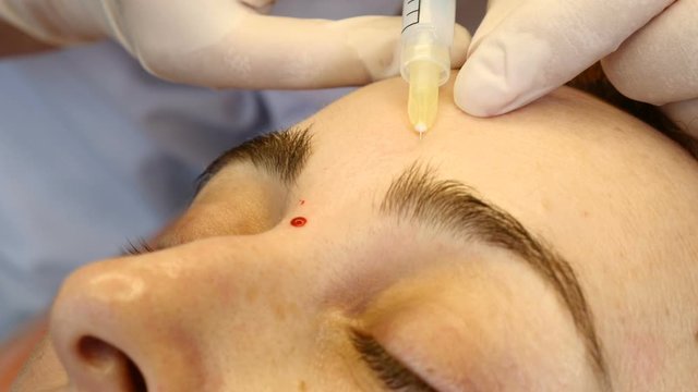 Needle mesotherapy in beauty spa salon or clinic. Cosmetics being injected to young woman, close-up. Beautician making multiple facial injections into female skin. Mesotherapy and face procedure. 4 k