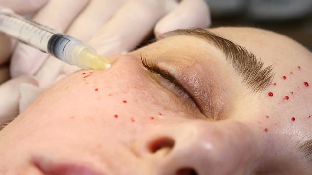 Anti-aging skin procedure: professional cosmetologist makes multiple facial injections leaving traces and papules. mesotherapy treatment in process. beautician holds syringe for injection. Close-up. 4