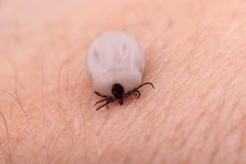 Tick (Ixodes ricinus) on human skin filled with blood. Danger insect can transmit both bacterial and viral pathogens such as the causative agents of Lyme disease and tick-borne encephalitis.