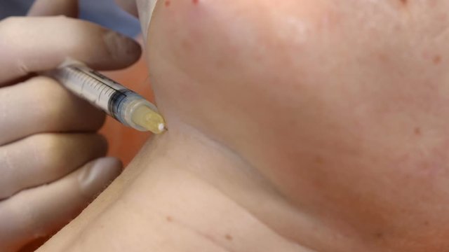 Anti-aging skin procedure: professional cosmetologist makes multiple facial injections leaving traces and papules. mesotherapy treatment in process. beautician holds syringe for injection. Close-up. 4