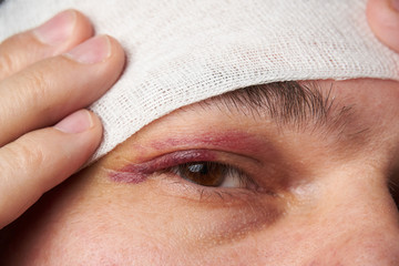 close view of a black eye, man's face with a hematoma