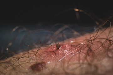 Macro photo of a tick stuck in the skin of a male person. Tick hiding between hair on a leg. Oil is being used to sedate and extract the tick.