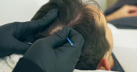 High quality close-up of a man laying on a couch during the esthetician hair treatment. Male tricopigmentation service. Scalp micropigmentation treatment. Trichopigmentation procedure.
