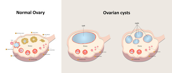 Comparison between normal ovary and ovarian cysts vector design.