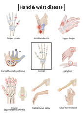 Medical illustration explaining Hand & wrist disease