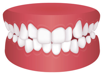 Teeth trouble ( bite type ) vector illustration /Crowding