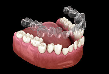 Invisalign braces or invisible retainer make bite correction. Medically accurate 3D illustration