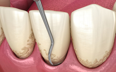 Closed curettage: Scaling and root planing (conventional periodontal therapy). Medically accurate 3D illustration of human teeth treatment