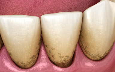 Tartar and bactrail tooth plaque, lower jaw. Medically accurate 3D illustration of human teeth treatment