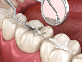 Molar tooth fissure restoration with filling. Medically accurate tooth 3D illustration.