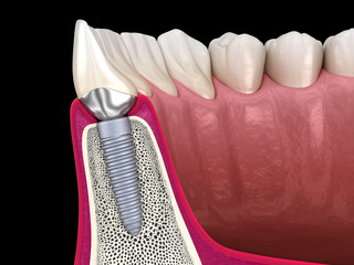 Custom abutment, dental implant and ceramic crown. Medically accurate tooth 3D illustration.