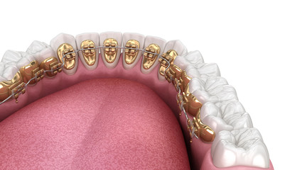 Healthy Teeth with gold braces, white teeth concept, dental 3D illustration