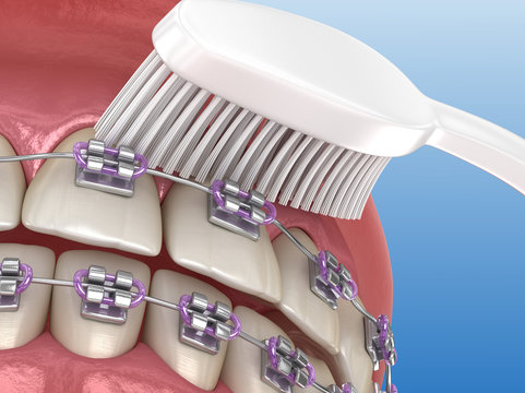 Toothbrush cleaning braces process. Medically accurate 3D illustration of oral hygiene.