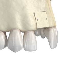 Bone grafting- augmentation using block of bone, tooth implantation. Medically accurate 3D illustration