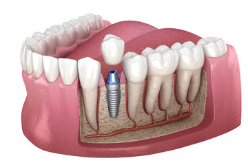 Premolar tooth crown installation over implant abutment. Medically accurate 3D illustration of human teeth and dentures concept - obrazy, fototapety, plakaty