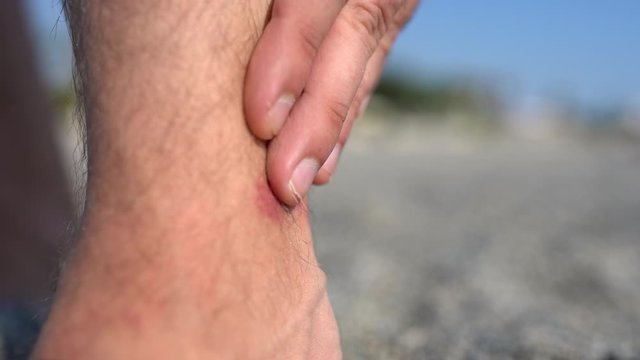 Skin inflammation on male's leg, red sore caused by insect, bed bugs, mosquito or flea bites. Skin infection and feeling itchy, parasites attacked human leg. Allergy and dermatology concept