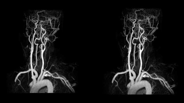 Magnetic Resonance Angiography(MRA)of the brain or cta brain 3D Rendering image white color rotating on the screen from mra scanner. medical footage concept..