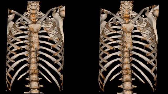 CT Scan Thoracic spine ct with 3D reconstruction . The film shown thoracolumbar injury after fall form height. Dark background