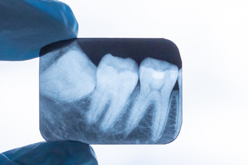 gloved dentist surgeon holds x-ray of lower retarded wisdom tooth