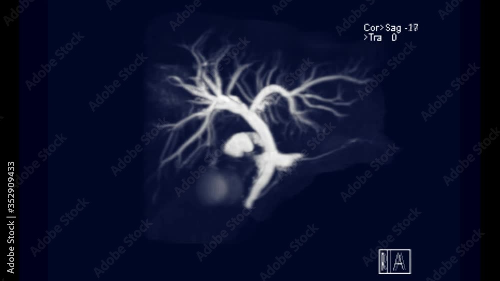 Aufkleber mrcp or magnetic resonance cholangiopancreatography 3d mip turn around on the screen showing visuali