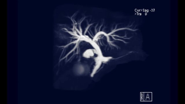 MRCP or Magnetic resonance cholangiopancreatography  3D MIP turn around on the screen  showing visualize the biliary and pancreatic ducts .