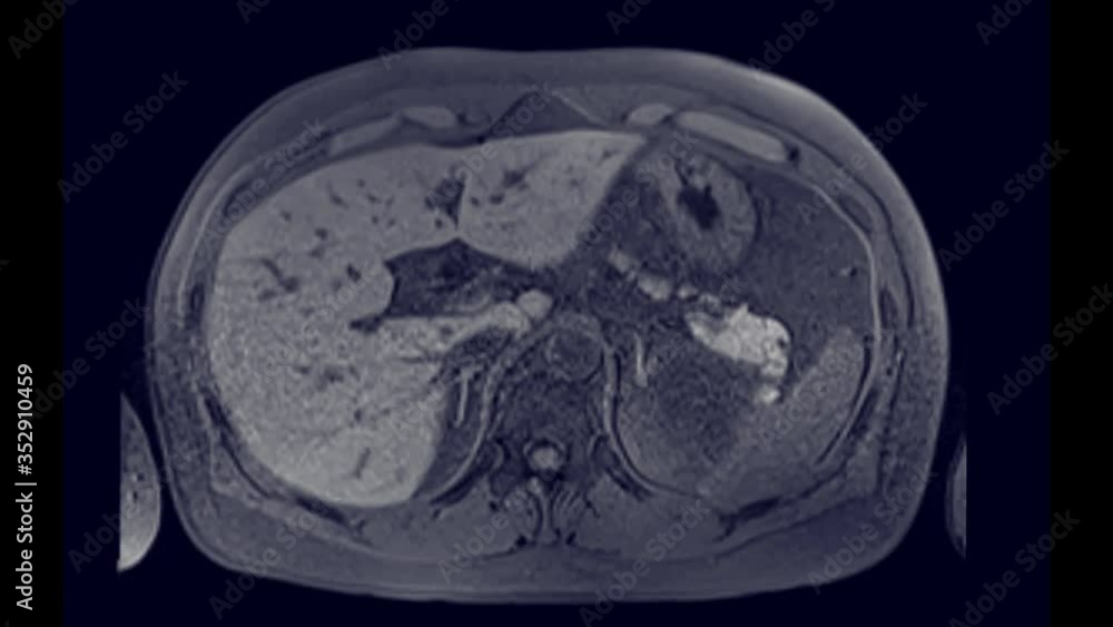 Poster mrcp or magnetic resonance cholangiopancreatography axial view showing visualize the biliary and pan