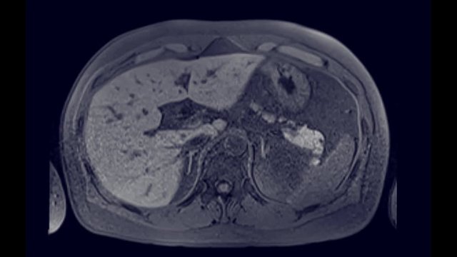 MRCP or Magnetic resonance cholangiopancreatography  axial view showing visualize the biliary and pancreatic ducts .