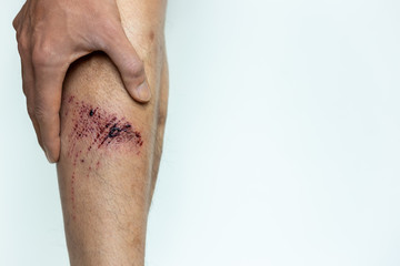 Red Wound injury on man leg with scabs, abrasion. Wound happen during young man working and fall down on the floor. He get injured at shin It is big wound. He get painful, touch wound. copy space