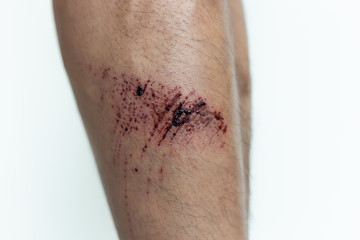 Red Wound injury on man leg with scabs, abrasion. Wound happen during young guy walking and fall down on floor. He get injured at shin. It is recovery, dry wound. He get painful, it would be scar