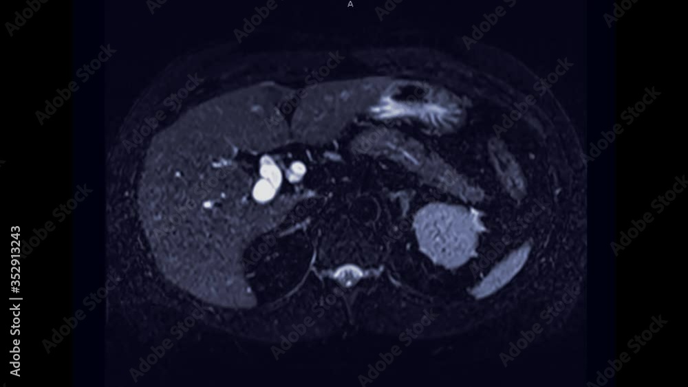 Poster mrcp or magnetic resonance cholangiopancreatography axial view showing visualize the biliary and pan