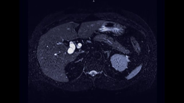 MRCP or Magnetic resonance cholangiopancreatography  axial view showing visualize the biliary and pancreatic ducts .