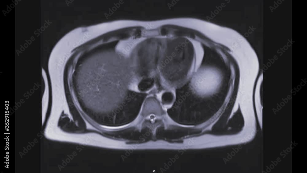 Poster mrcp or magnetic resonance cholangiopancreatography axial view showing visualize the biliary and pan