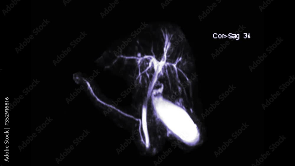 Poster mrcp or magnetic resonance cholangiopancreatography 3d mip view showing visualize the biliary and pa
