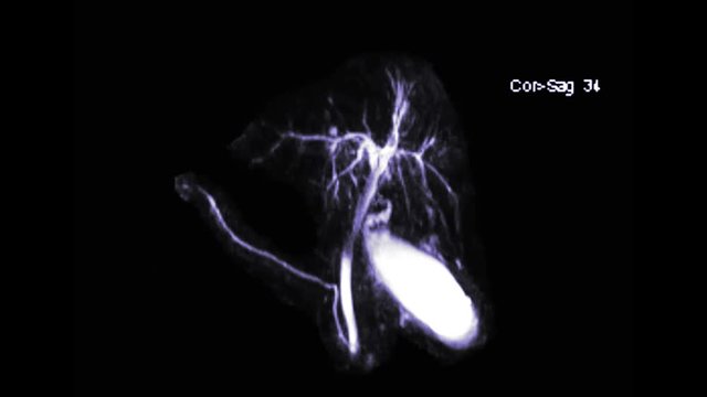 MRCP or Magnetic resonance cholangiopancreatography  3D MIP view showing visualize the biliary and pancreatic ducts .