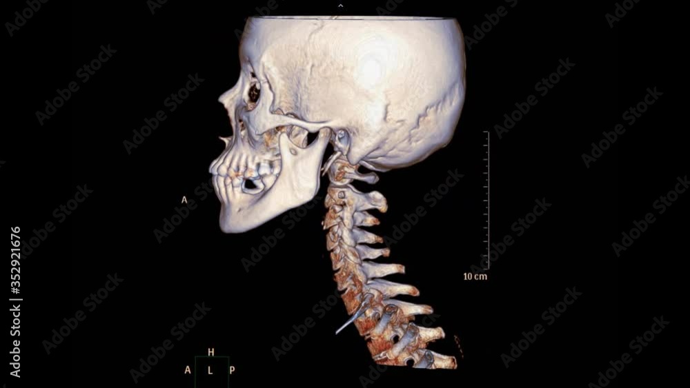 Poster ct c-spine or cervical spine 3d rendering image of patient trauma case turn around on the monitor . 