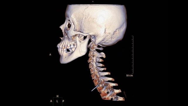 CT C-spine  or Cervical Spine 3d rendering image of  patient trauma case turn around on the monitor . Medical technology concept.