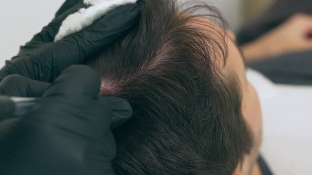 High quality close-up 4k slow motion video of a man laying on a couch during the esthetician hair treatment. Male tricopigmentation service. Scalp micropigmentation treatment. Trichopigmentation proce
