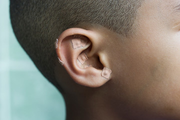 Auriculotherapy, or auricular therapy, or ear acupuncture, or auriculoacupuncture is a form of...