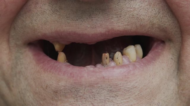 A man shows his rotten teeth. Periodontal disease. Sawn teeth before prosthetics. Teeth with caries.