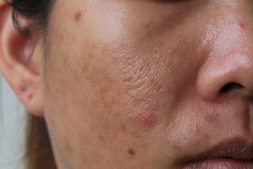 Large pore and blemish Asian skin - obrazy, fototapety, plakaty