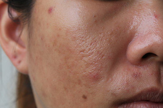 Large pore and blemish Asian skin