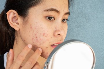 Portrait of Asian woman worry about her face when she saw the problem of acne inflammation and scar...