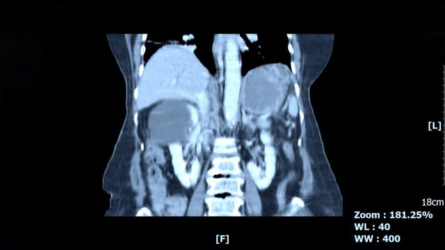 CT scan of abdomen by mri scan abdominal and front body.