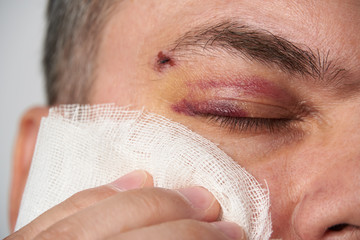 close view of a black eye, man's face with a hematoma