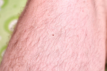 Mole on the male hairy leg.