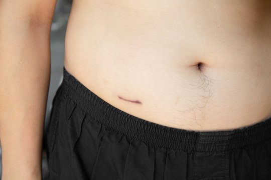 Closeup Of Man Showing The Stomach With A Scar From Appendicitis Surgery.